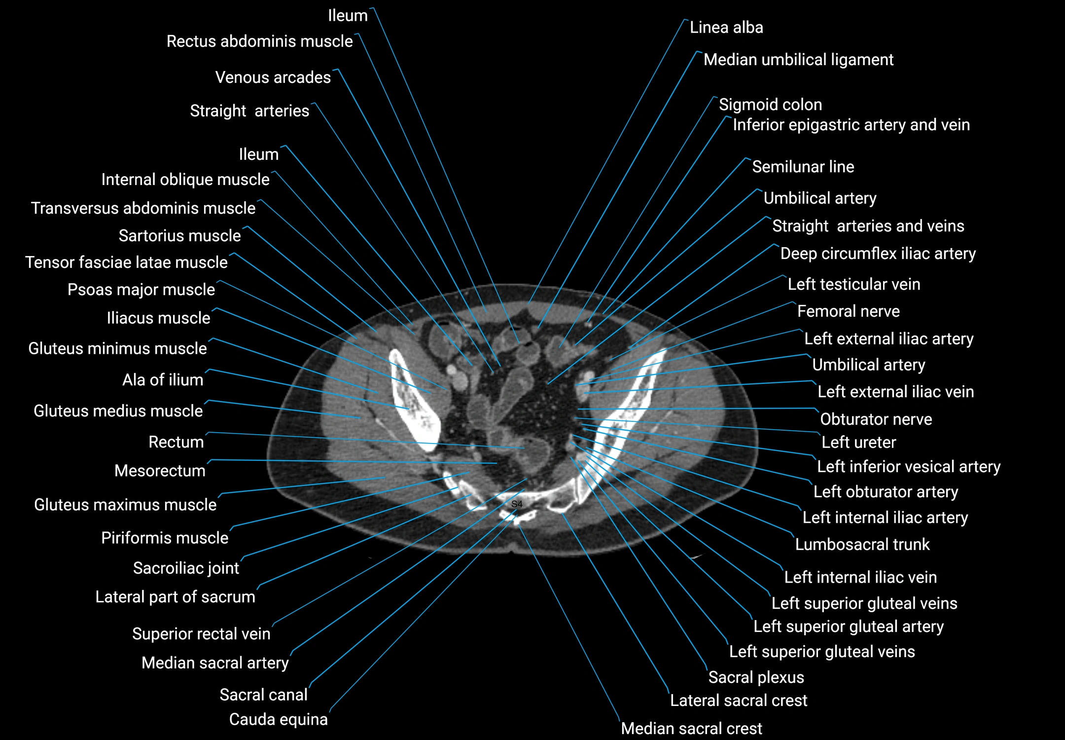 CT male pelvis axial cross sectional anatomy labelled radiology image -00164.webp